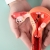 Síndrome de Ovario Poliquístico (SOP): una condición frecuente y no siempre diagnosticada