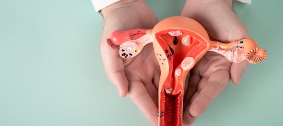 Síndrome de Ovario Poliquístico (SOP): una condición frecuente y no siempre diagnosticada